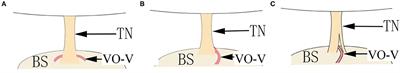 Microvascular Decompression for Trigeminal Neuralgia Caused by Venous Offending on the Ventral Side of the Root Entrance/Exit Zone: Classification and Management Strategy